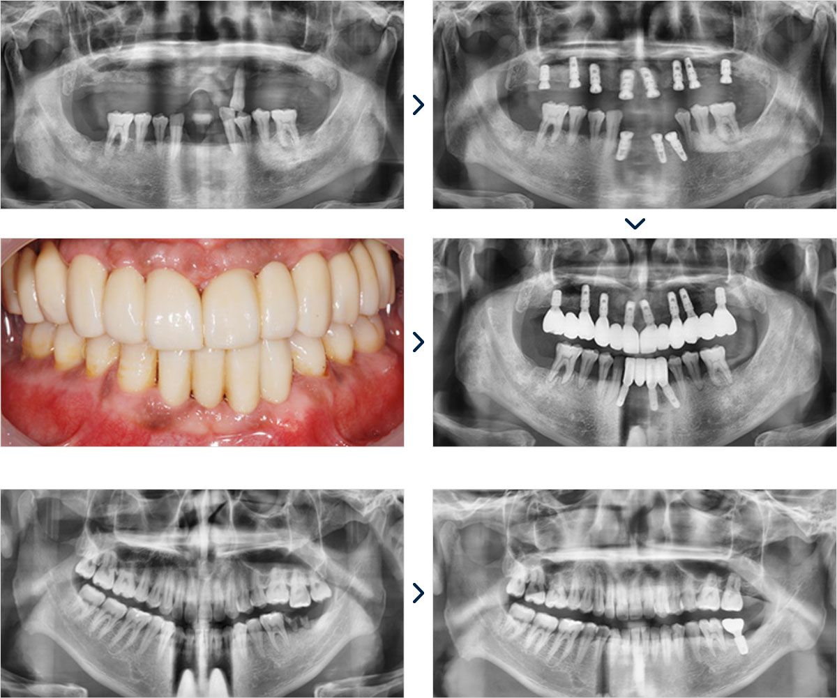 임플란트사례1